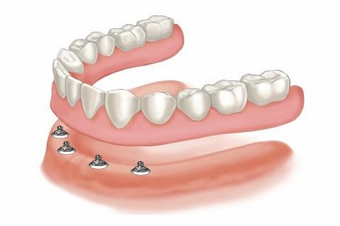Denture Stabilisation Treatment Northern Ireland