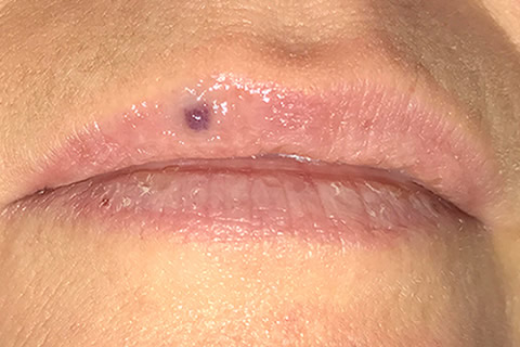 Venous Lake Lip Treatment Northern Ireland